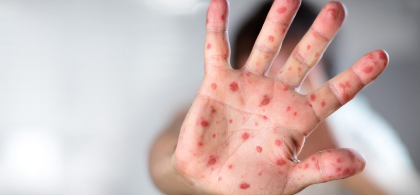 Viral Diseases - Hand Infected - Hand foot and mouth disease HFMD